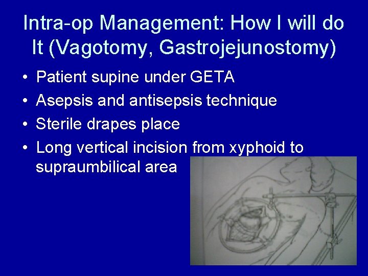 Intra-op Management: How I will do It (Vagotomy, Gastrojejunostomy) • • Patient supine under