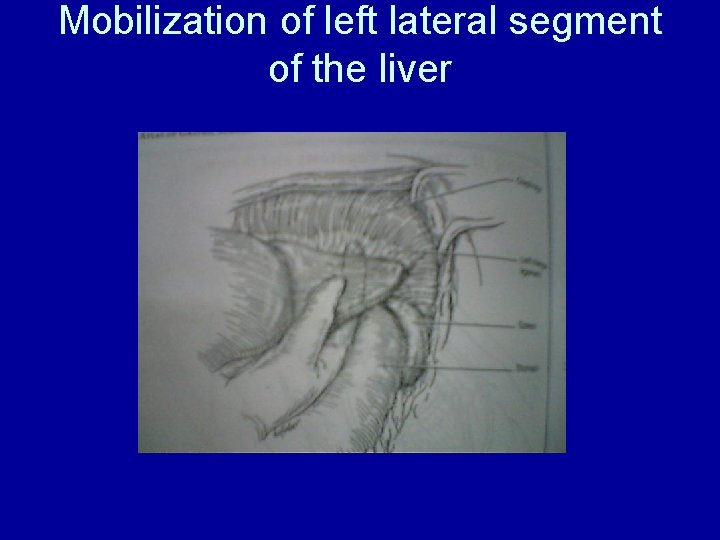 Mobilization of left lateral segment of the liver 