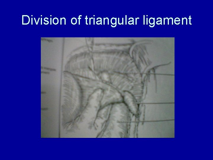 Division of triangular ligament 