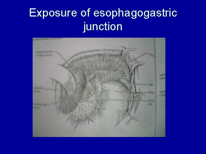 Exposure of esophagogastric junction 