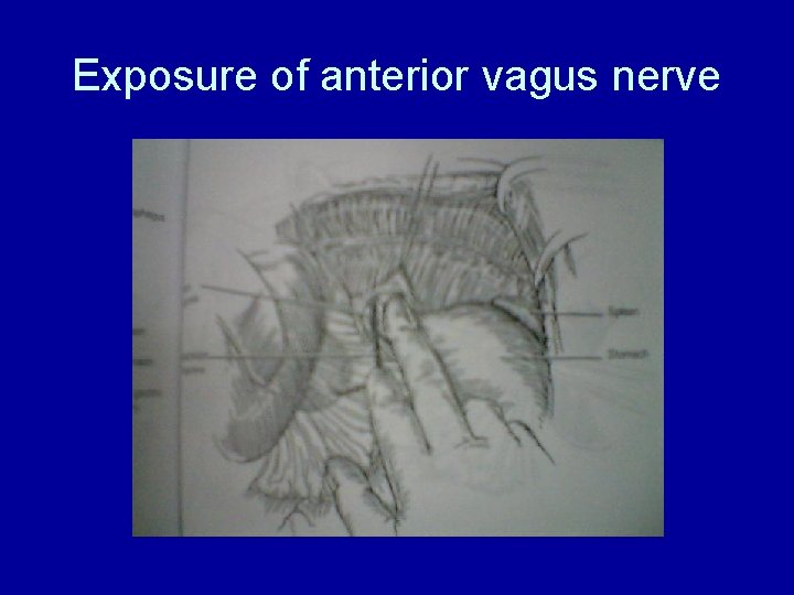 Exposure of anterior vagus nerve 