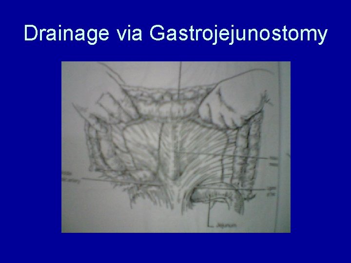 Drainage via Gastrojejunostomy 