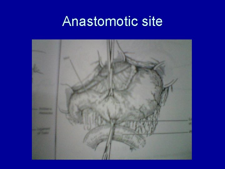 Anastomotic site 