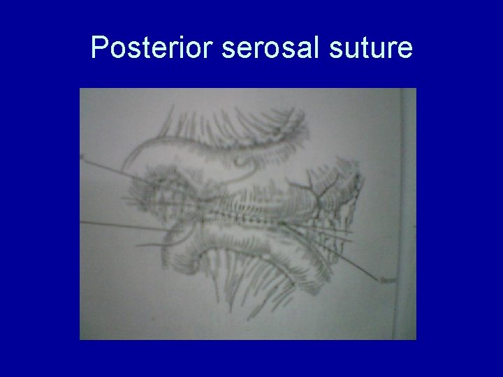 Posterior serosal suture 