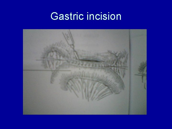 Gastric incision 