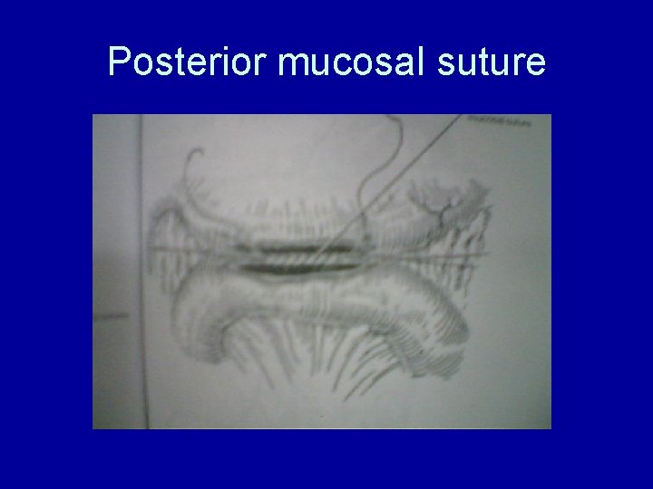 Posterior mucosal suture 