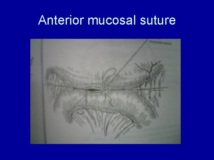 Anterior mucosal suture 