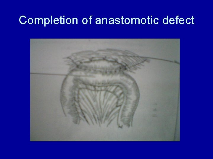 Completion of anastomotic defect 