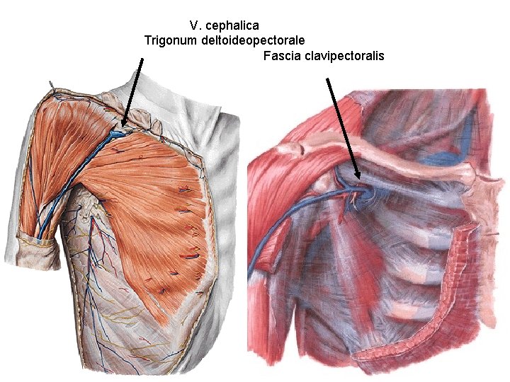 V. cephalica Trigonum deltoideopectorale Fascia clavipectoralis 