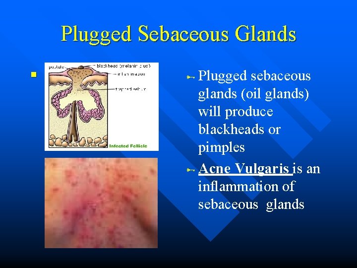 Plugged Sebaceous Glands Plugged n n sebaceous glands (oil glands) will produce blackheads or Plugged Sebaceous Glands Plugged n n sebaceous glands (oil glands) will produce blackheads or