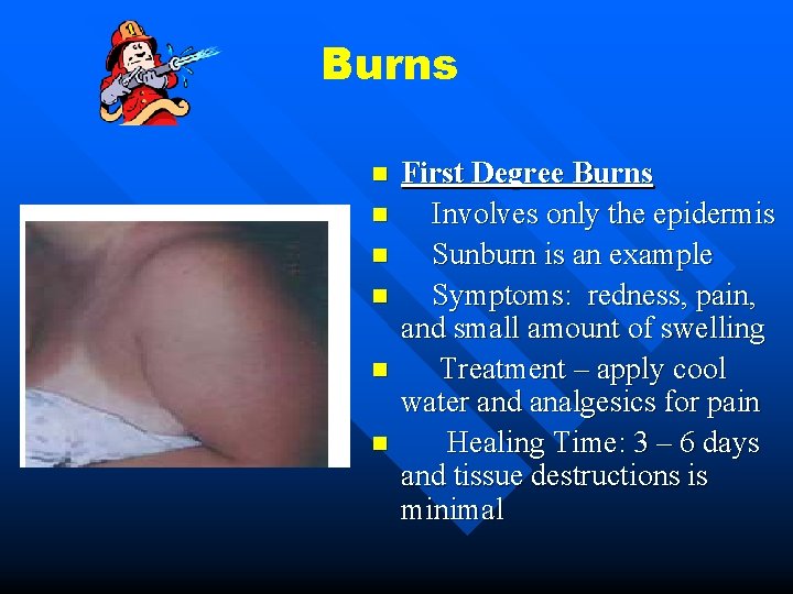 Burns n n n First Degree Burns Involves only the epidermis Sunburn is an Burns n n n First Degree Burns Involves only the epidermis Sunburn is an