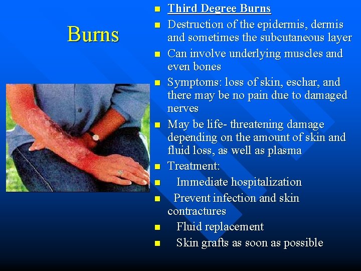 n Burns n n n n n Third Degree Burns Destruction of the epidermis, n Burns n n n n n Third Degree Burns Destruction of the epidermis,