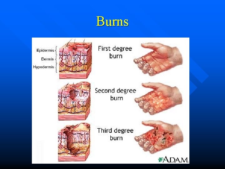 Burns Burns