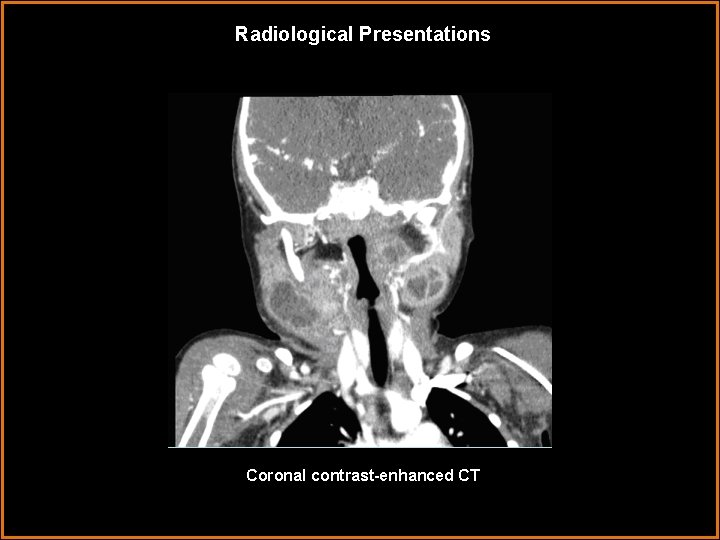 Radiological Presentations Coronal contrast-enhanced CT 