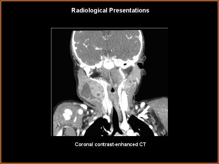 Radiological Presentations Coronal contrast-enhanced CT 