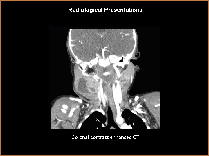 Radiological Presentations Coronal contrast-enhanced CT 