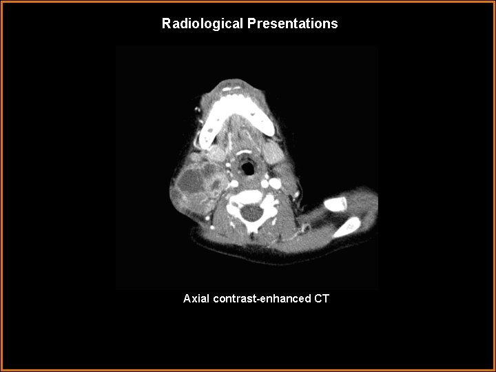 Radiological Presentations Axial contrast-enhanced CT 