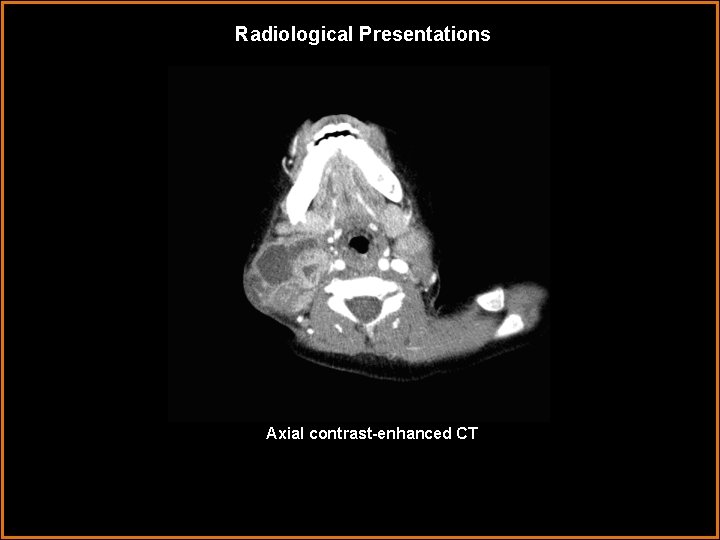 Radiological Presentations Axial contrast-enhanced CT 