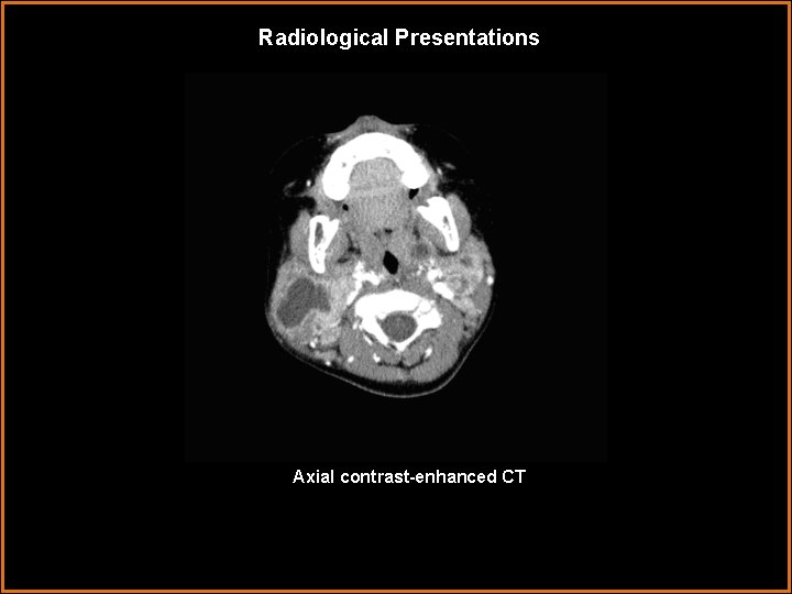 Radiological Presentations Axial contrast-enhanced CT 