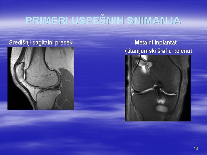 PRIMERI USPEŠNIH SNIMANJA Središnji sagitalni presek Metalni inplantat ( titanijumski šraf u kolenu) 10