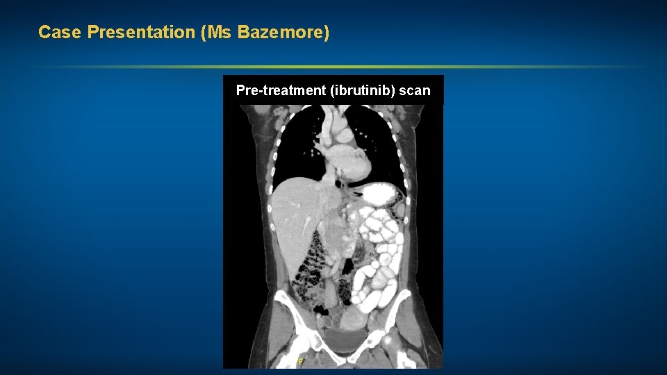 Case Presentation (Ms Bazemore) Pre-treatment (ibrutinib) scan 