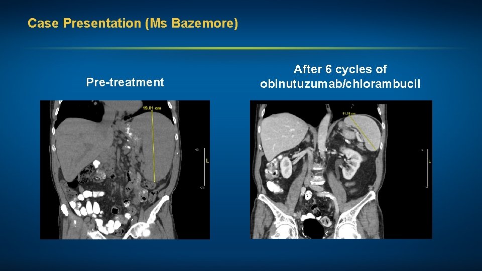 Case Presentation (Ms Bazemore) Pre-treatment After 6 cycles of obinutuzumab/chlorambucil 