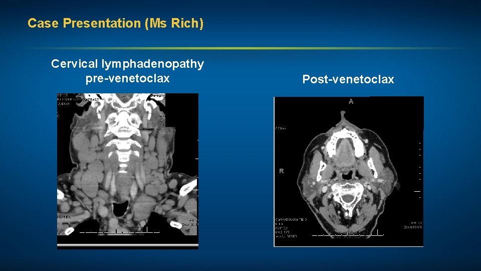 Case Presentation (Ms Rich) Cervical lymphadenopathy pre-venetoclax Post-venetoclax 