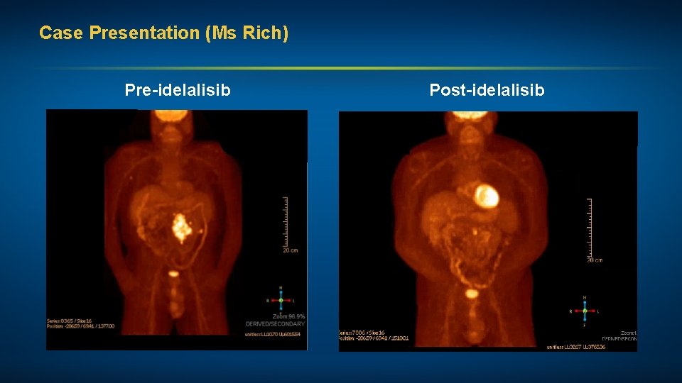 Case Presentation (Ms Rich) Pre-idelalisib Post-idelalisib 