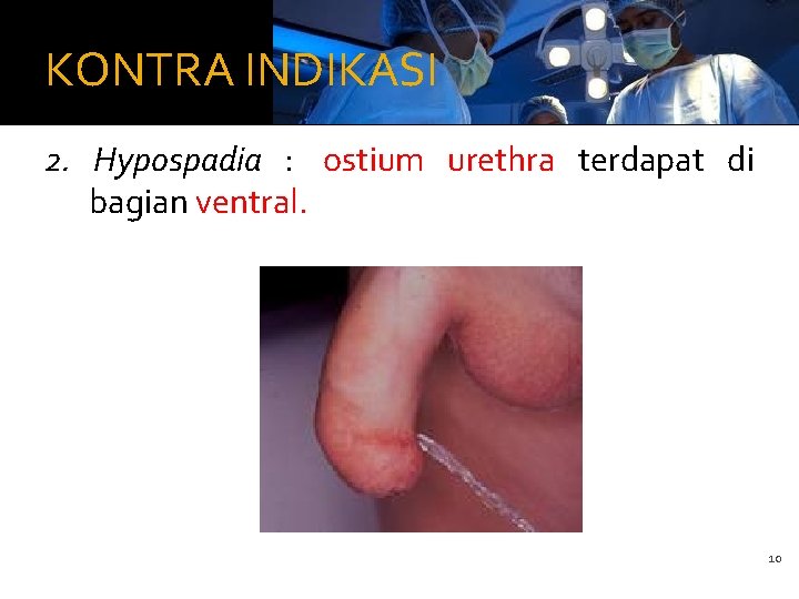 KONTRA INDIKASI 2. Hypospadia : ostium urethra terdapat di bagian ventral. 10 