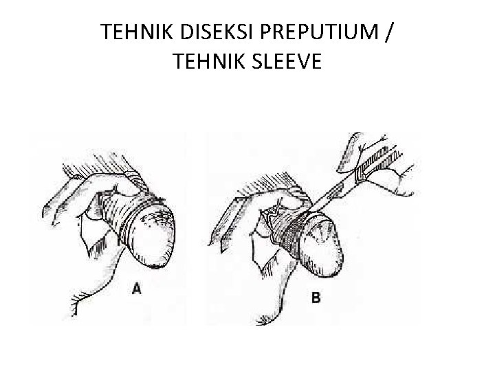 TEHNIK DISEKSI PREPUTIUM / TEHNIK SLEEVE 