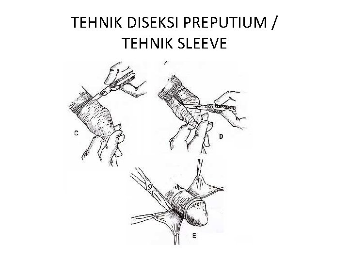 TEHNIK DISEKSI PREPUTIUM / TEHNIK SLEEVE 