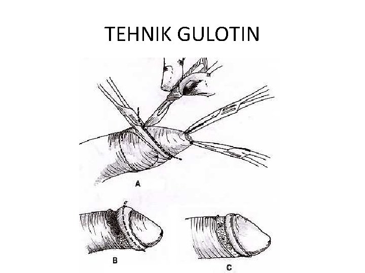 TEHNIK GULOTIN 