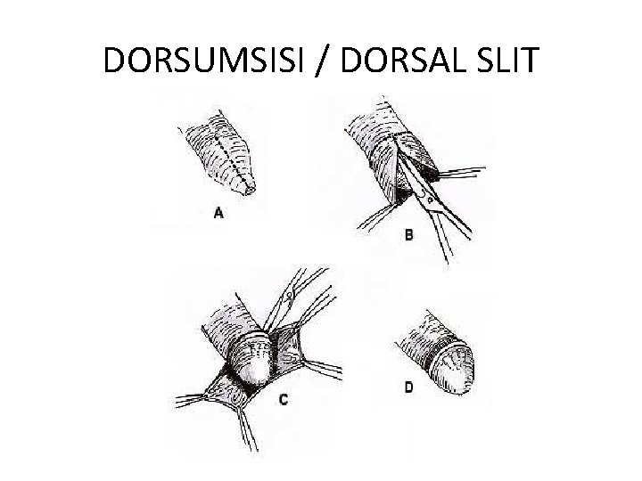 DORSUMSISI / DORSAL SLIT 