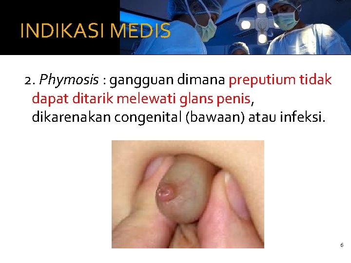 INDIKASI MEDIS 2. Phymosis : gangguan dimana preputium tidak dapat ditarik melewati glans penis,