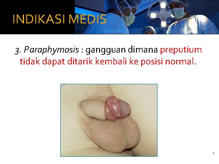 INDIKASI MEDIS 3. Paraphymosis : gangguan dimana preputium tidak dapat ditarik kembali ke posisi