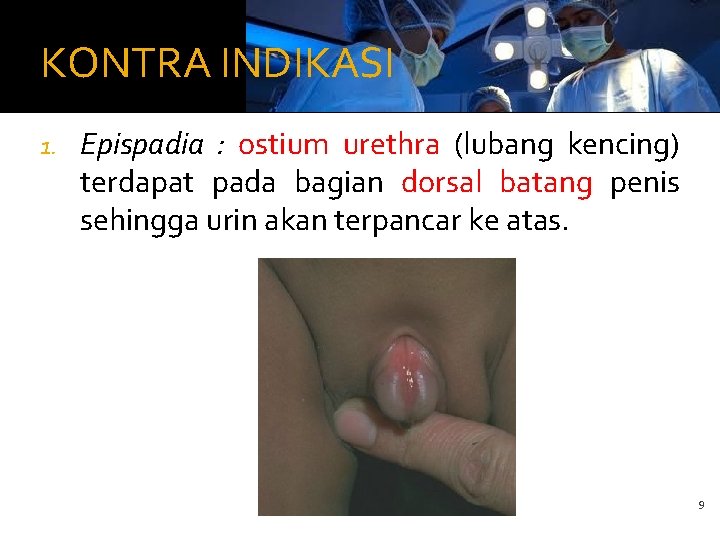 KONTRA INDIKASI 1. Epispadia : ostium urethra (lubang kencing) terdapat pada bagian dorsal batang