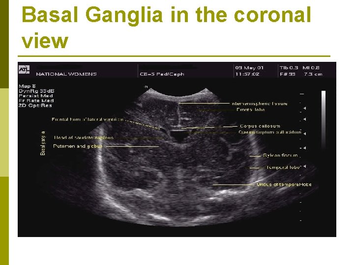 Basal Ganglia in the coronal view 