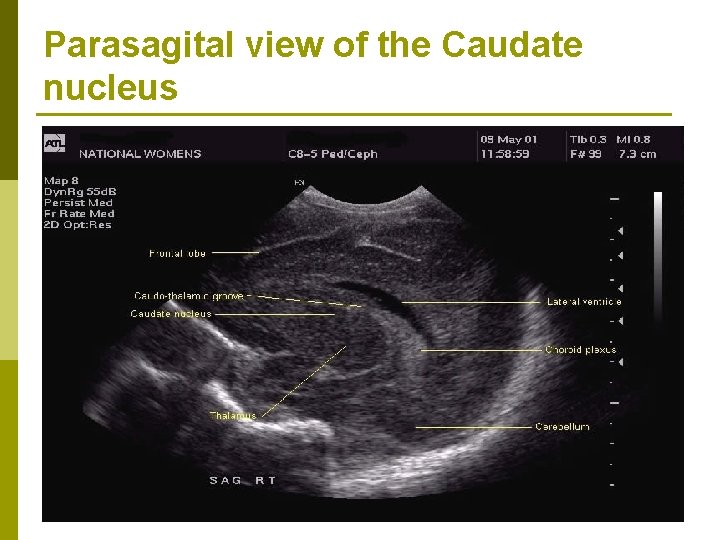 Parasagital view of the Caudate nucleus 