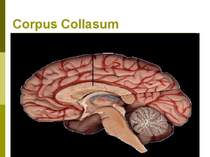 Corpus Collasum 