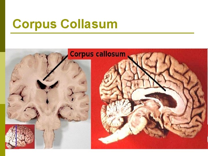 Corpus Collasum Corpus Collasum