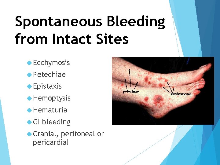 Spontaneous Bleeding from Intact Sites Ecchymosis Petechiae Epistaxis Hemoptysis Hematuria GI bleeding Cranial, peritoneal