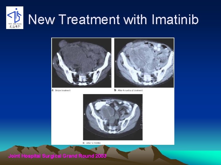 New Treatment with Imatinib Joint Hospital Surgical Grand Round 2003 