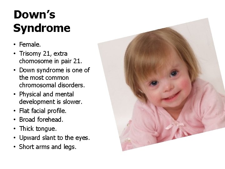 Down’s Syndrome • Female. • Trisomy 21, extra chomosome in pair 21. • Down