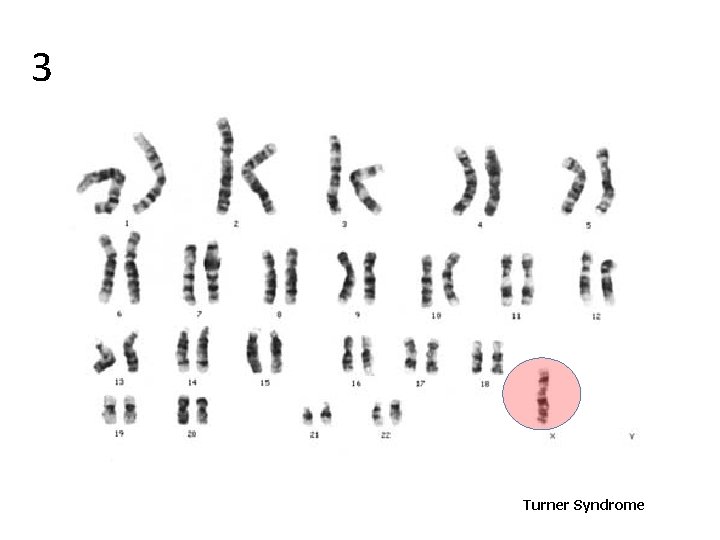 3 Turner Syndrome 