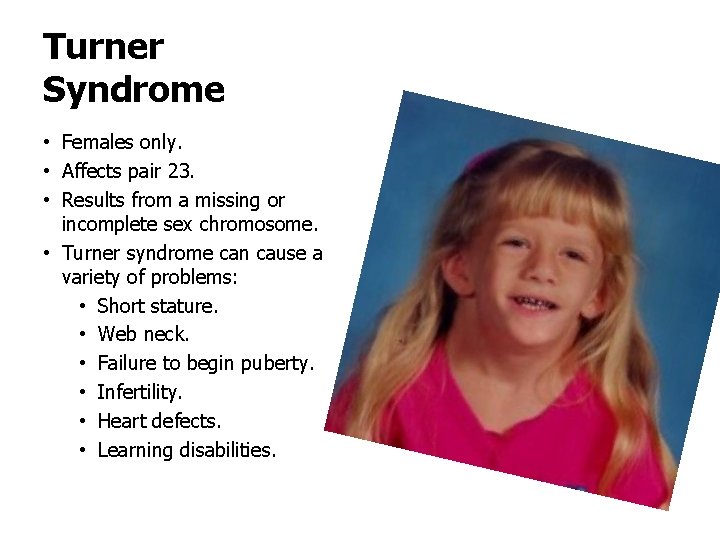 Turner Syndrome • Females only. • Affects pair 23. • Results from a missing