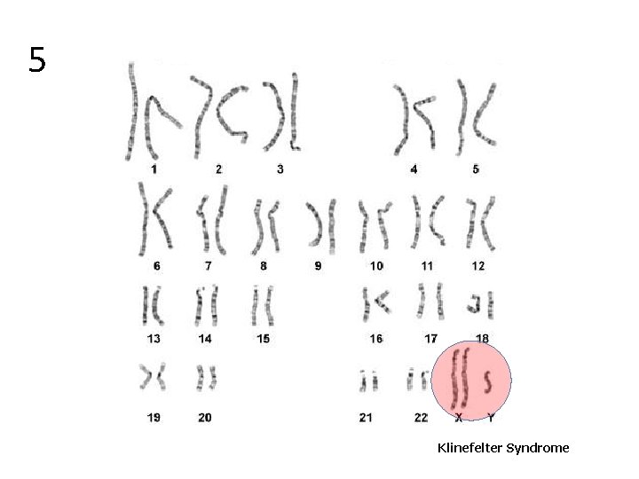5 Klinefelter Syndrome 
