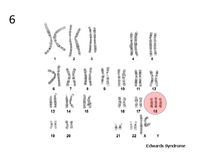 6 Edwards Syndrome 