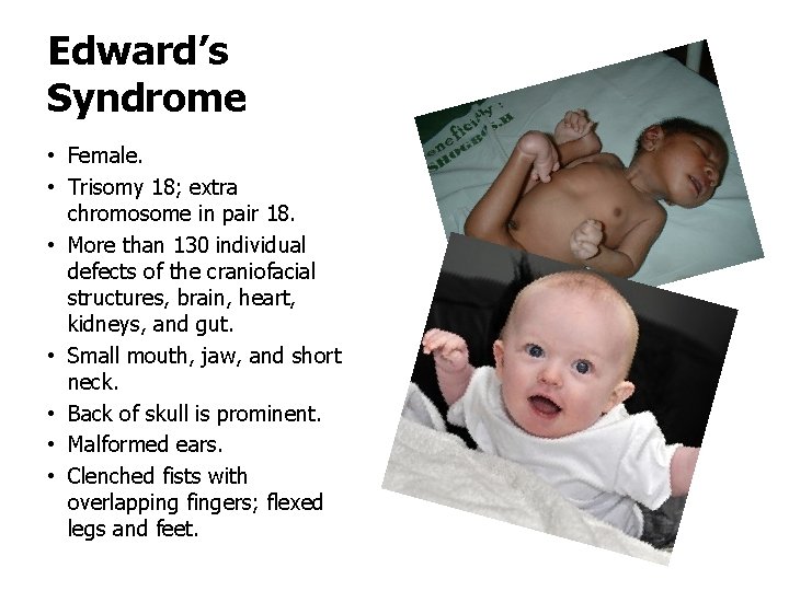 Edward’s Syndrome • Female. • Trisomy 18; extra chromosome in pair 18. • More