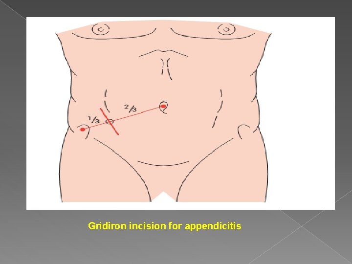 Gridiron incision for appendicitis Gridiron incision for appendicitis