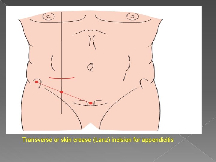 Transverse or skin crease (Lanz) incision for appendicitis 